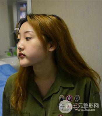 終于做了下頜角整形，分享術(shù)后恢復(fù)果