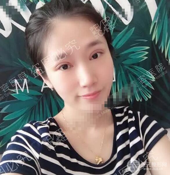 伊美爾秦宏偉雙眼皮案例術(shù)后15天果圖展示