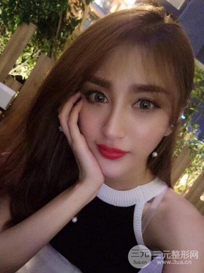 重慶鉑生王振榮隆鼻整形前后對比圖恢復過程分享