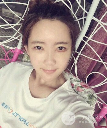 全臉自體脂肪填充手術(shù)日記分享，改良臉型年輕十歲