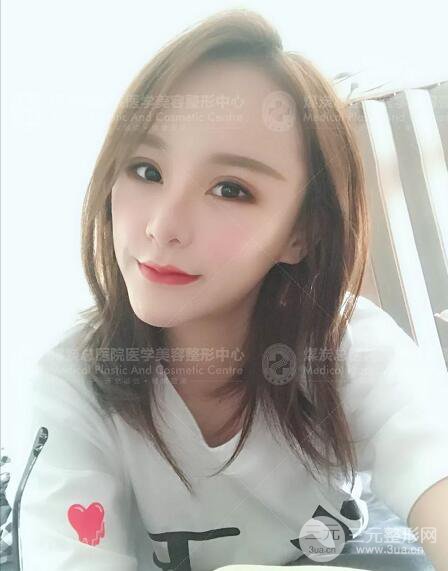 煤炭總醫(yī)院整形美容科自體脂肪填充案例
