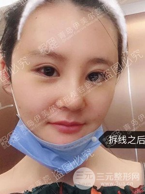 青島伊美爾隆鼻整形案例恢復(fù)過程前后對比圖分享