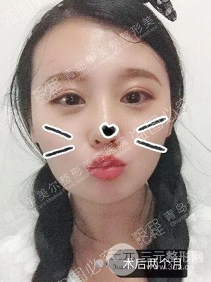 青島伊美爾隆鼻整形案例恢復(fù)過程前后對比圖分享