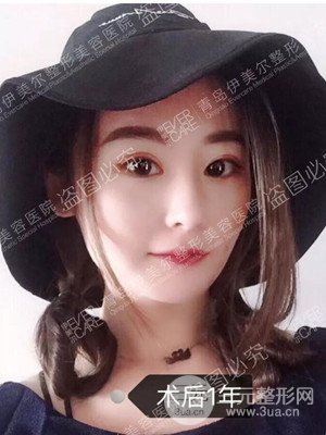青島伊美爾隆鼻整形案例恢復(fù)過程前后對比圖分享