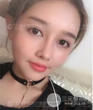 隆鼻失敗修復+詳細部自體脂肪填充案例分享，上海華美做的!