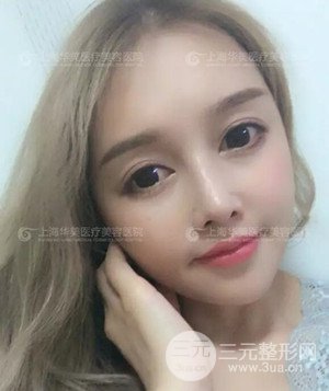 隆鼻失敗修復+詳細部自體脂肪填充案例分享，上海華美做的!