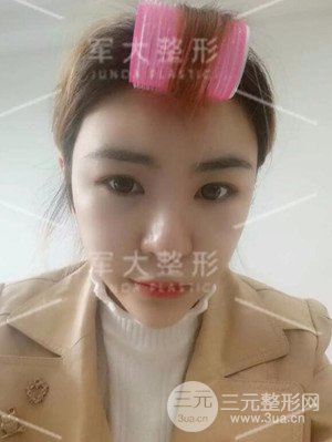 四川軍大自體脂肪面部填充案例分享