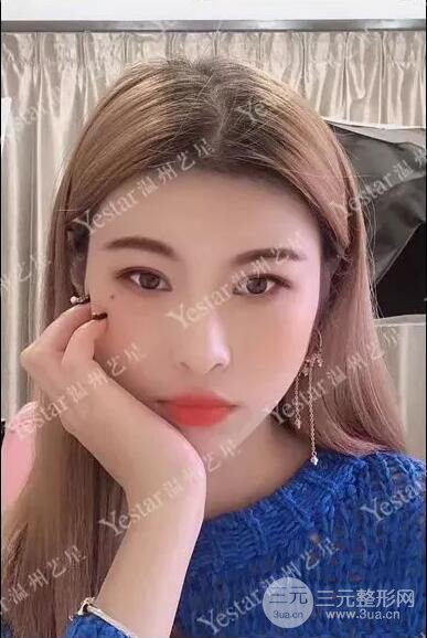 溫州藝星雙眼皮+隆鼻+自體脂肪填充案例果圖片