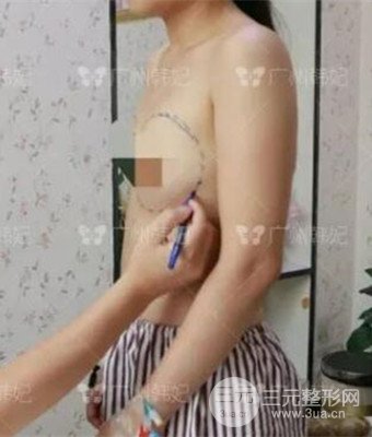 廣州韓妃劉志剛自體脂肪豐胸案例前后對(duì)比圖分享~