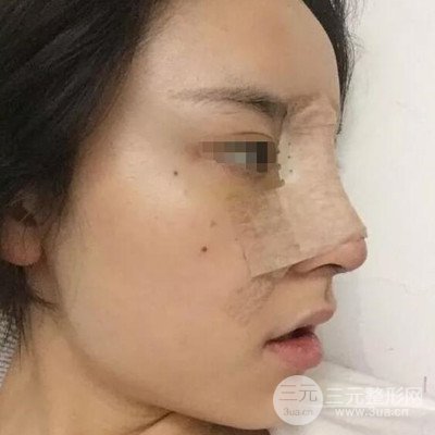 廣州艾美周琮鎮(zhèn)隆鼻案例前后對比圖分享~