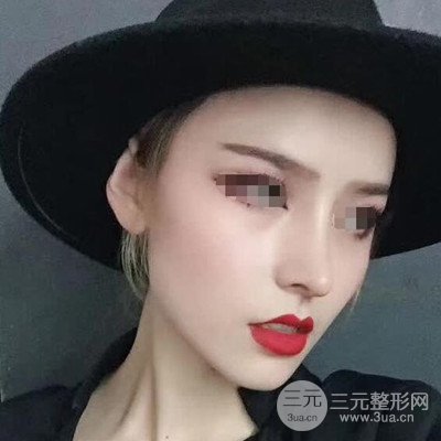 廣州艾美周琮鎮(zhèn)隆鼻案例前后對比圖分享~