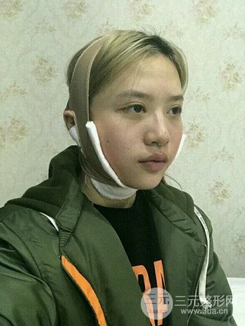 大圓臉做了面部吸脂瘦臉果很棒，立現(xiàn)漂亮鵝蛋臉