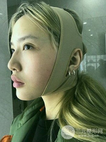 大圓臉做了面部吸脂瘦臉果很棒，立現(xiàn)漂亮鵝蛋臉