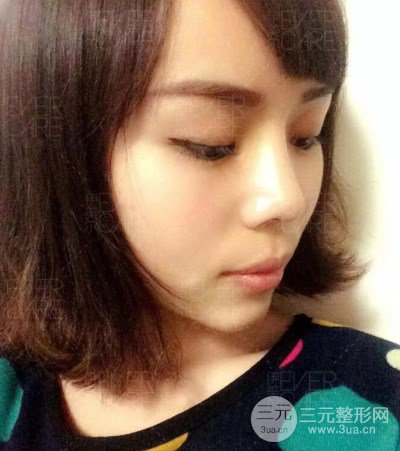 北京伊美爾徐軍假體隆鼻前后對比照片心情日記