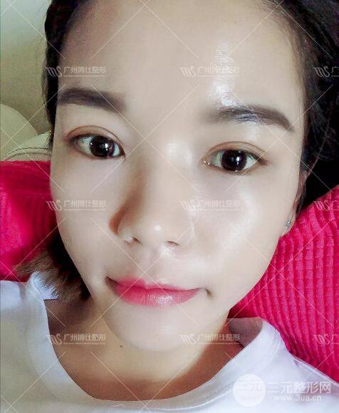 廣州博仕整形雙眼皮案例術(shù)后恢復(fù)日記