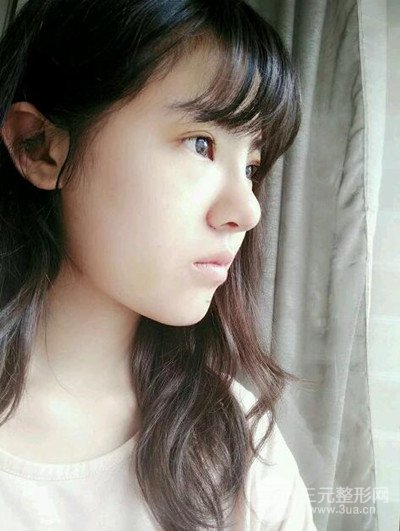 廣州美萊李高峰隆鼻整形案例前后對(duì)比圖分享~