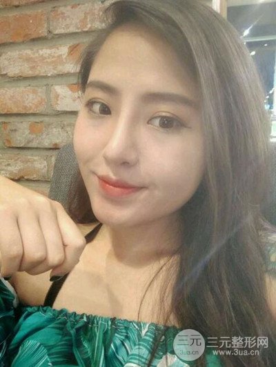 廣州美萊李高峰隆鼻整形案例前后對(duì)比圖分享~