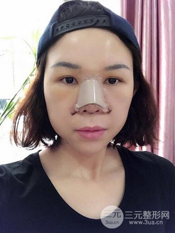 隆鼻整形手術(shù)真人案例恢復(fù)過程分享 附上果圖