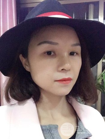 隆鼻整形手術(shù)真人案例恢復(fù)過程分享 附上果圖