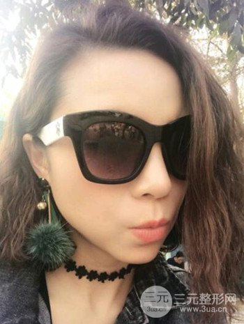 隆鼻整形手術(shù)真人案例恢復(fù)過程分享 附上果圖