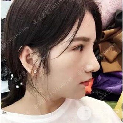 北京藝星隆鼻整形案例前后對比圖分享~