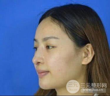 吉林銘醫(yī)李紅肋骨隆鼻整形前后對(duì)比圖果恢復(fù)心情小札