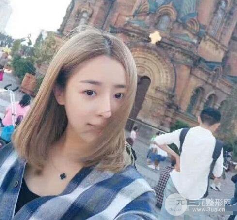 吉林銘醫(yī)李紅肋骨隆鼻整形前后對(duì)比圖果恢復(fù)心情小札