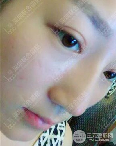 深圳聯(lián)合麗格線D隆鼻恢復(fù)日記以及前后對比圖分享！