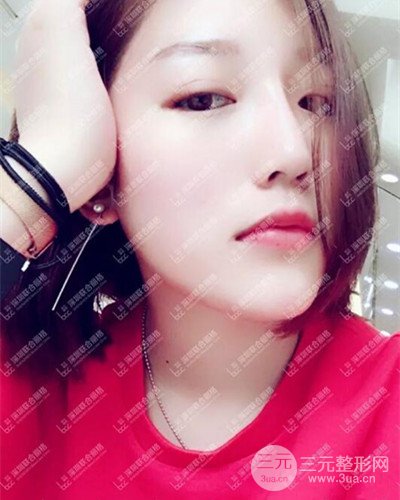 深圳聯(lián)合麗格線D隆鼻恢復(fù)日記以及前后對比圖分享！