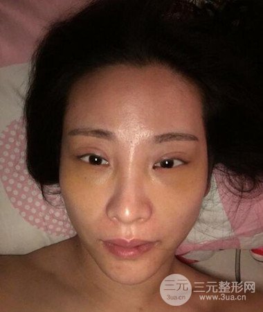 內(nèi)切微創(chuàng)去眼袋手術(shù)案例分享，附上手術(shù)恢復(fù)照片