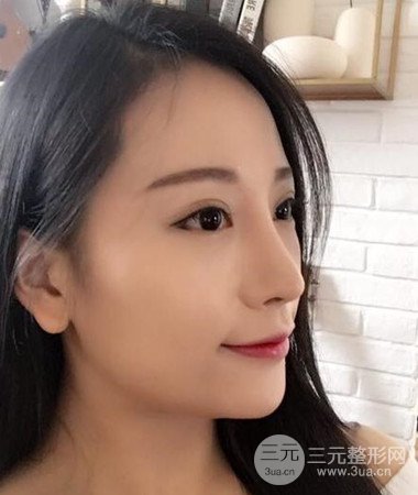 內(nèi)切微創(chuàng)去眼袋手術(shù)案例分享，附上手術(shù)恢復(fù)照片