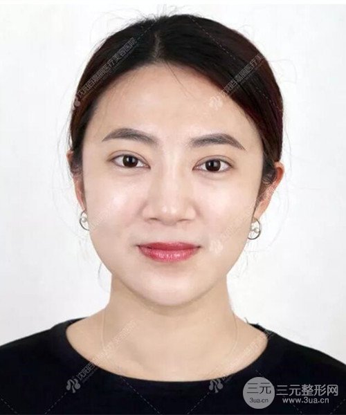 沈陽百嘉麗雙眼皮+開眼角恢復(fù)日記以及前后對(duì)比圖分享~