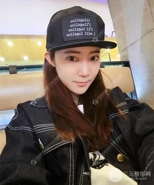 沈陽百嘉麗雙眼皮+開眼角恢復(fù)日記以及前后對(duì)比圖分享~