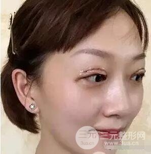 吉林銘醫(yī)李紅雙眼皮修復(fù)前后對(duì)比圖 內(nèi)附吉林銘醫(yī)小彩蛋哦