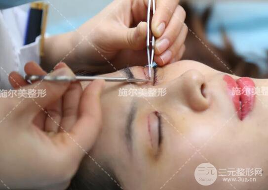 南京施爾美孫欣雙眼皮案例果恢復(fù)圖