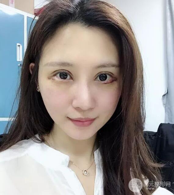 蘭大二院張選奮怎么樣?雙眼皮修復(fù)案例前后對(duì)比圖