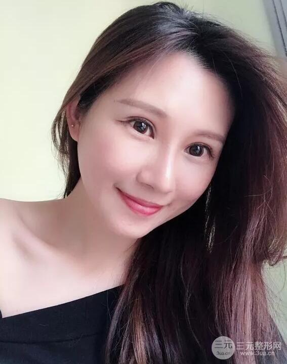 蘭大二院張選奮怎么樣?雙眼皮修復(fù)案例前后對(duì)比圖