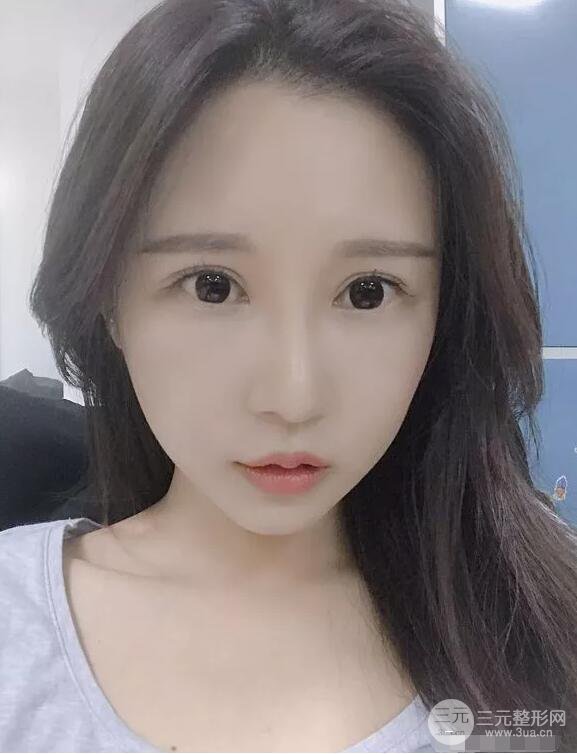 蘭大二院張選奮怎么樣?雙眼皮修復(fù)案例前后對(duì)比圖