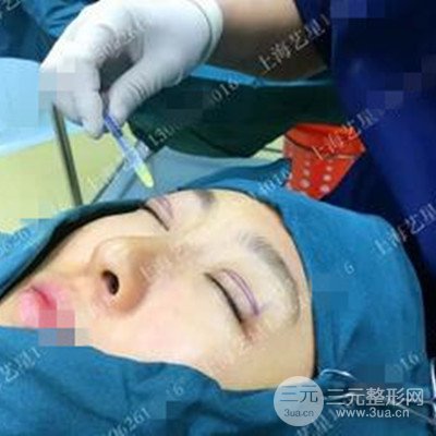 上海藝星雙眼皮日記分享，割雙眼皮后大變樣！