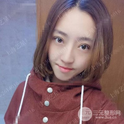 上海藝星雙眼皮日記分享，割雙眼皮后大變樣！