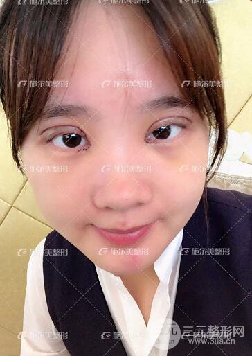 南京施爾美整形孫欣雙眼皮案例恢復(fù)日記