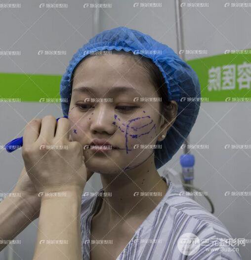 南京施爾美整形孫欣線D案例,重返17歲！