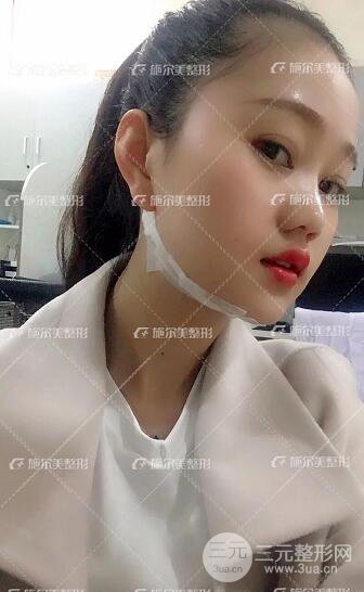 南京施爾美整形孫欣線D案例,重返17歲！
