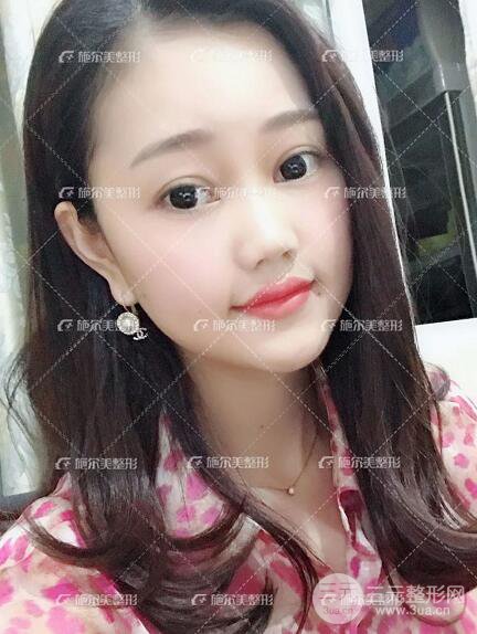 南京施爾美整形孫欣線D案例,重返17歲！