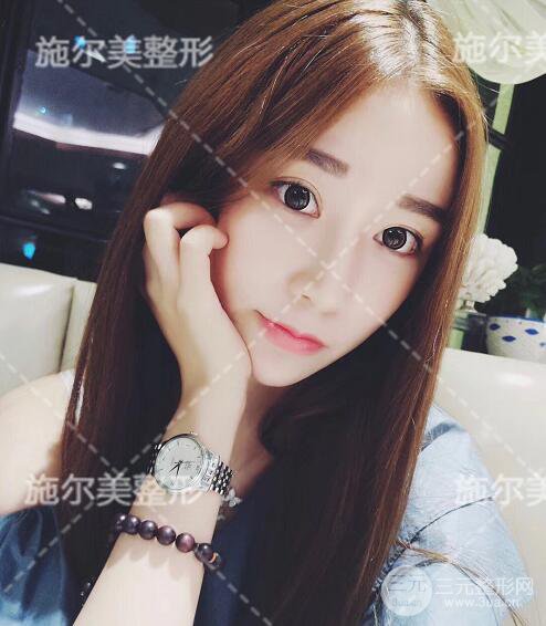 南京施爾美自體脂肪填充案例,拒絕“壽星公”！