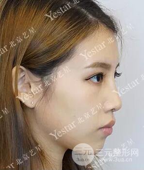 北京藝星仇侃敏耳軟骨隆鼻恢復過程|內(nèi)附前后對比圖