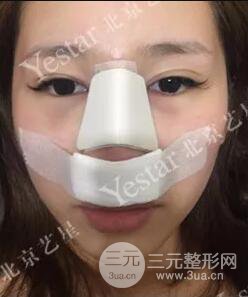北京藝星仇侃敏耳軟骨隆鼻恢復過程|內(nèi)附前后對比圖