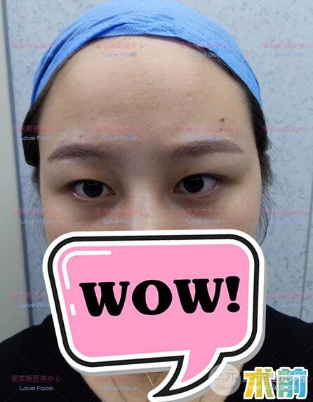 揚州艾菲斯黃嬋院長雙眼皮案例術(shù)后七天果