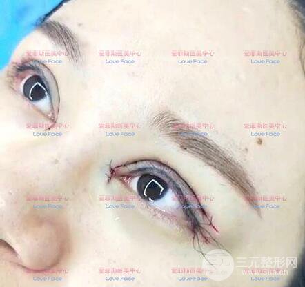 揚州艾菲斯黃嬋院長雙眼皮案例術(shù)后七天果