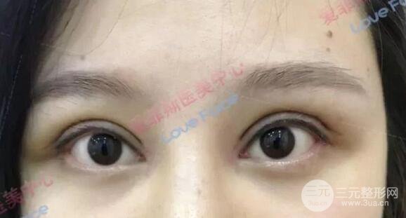 揚州艾菲斯黃嬋院長雙眼皮案例術(shù)后七天果